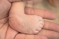 Facts About Clubfoot