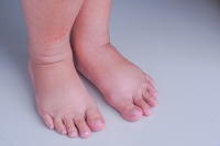 Factors Behind Foot Swelling