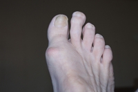 Causes and Solutions for Second Toe Pain