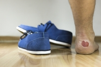 Different Causes of Blisters