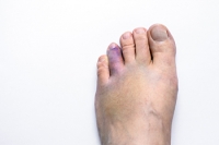 Tips for a Speedy Recovery From a Broken Toe